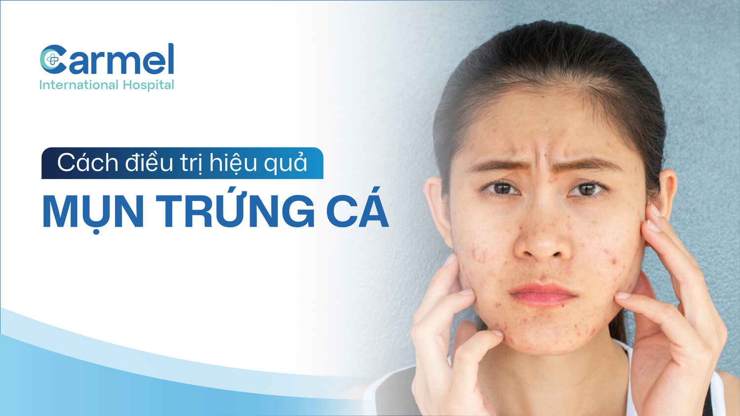 Các phương pháp điều trị mụn trứng cá hiện nay