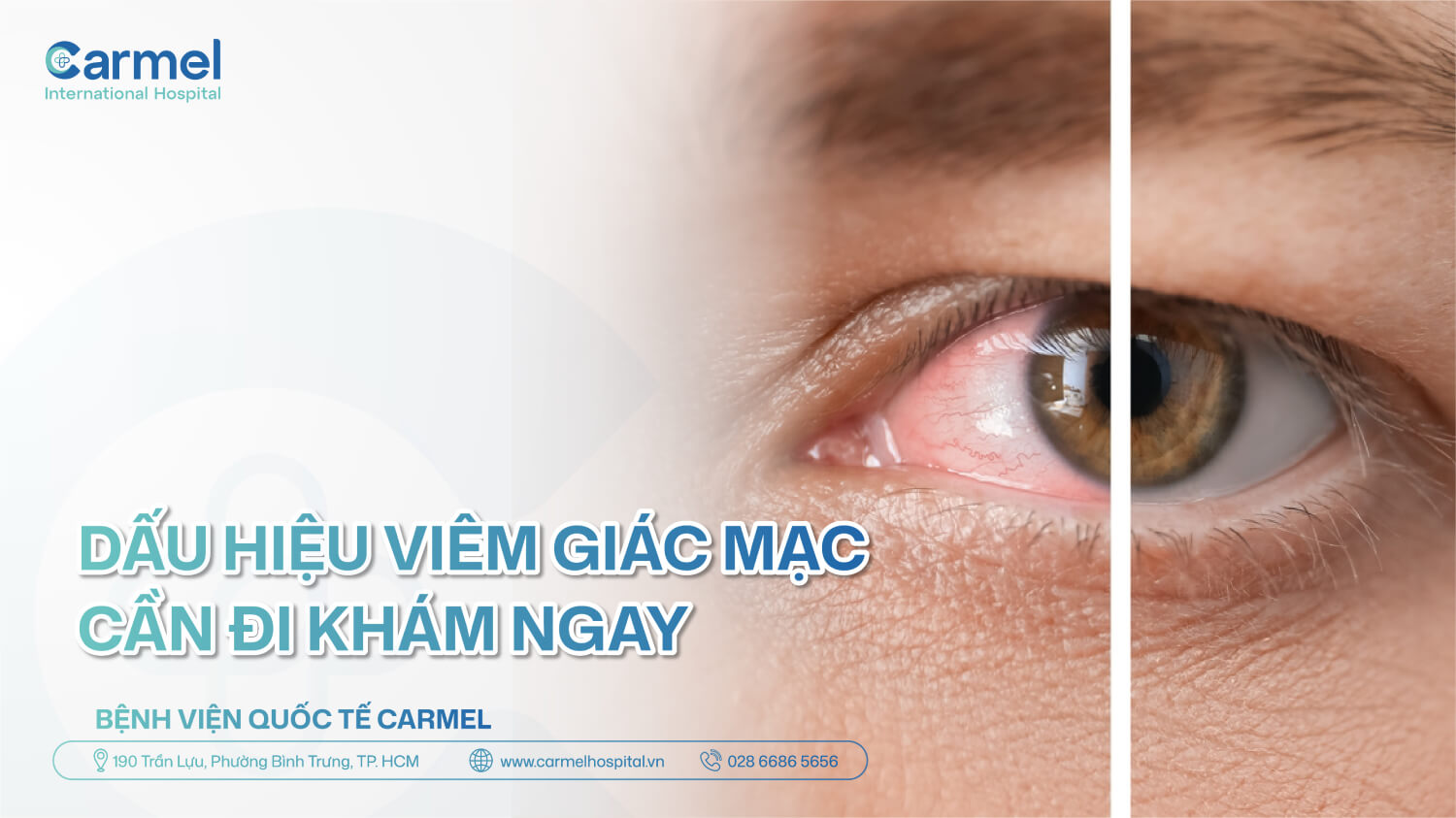 Dấu hiệu viêm giác mạc: Khi nào cần đi khám ngay trong 24 giờ?