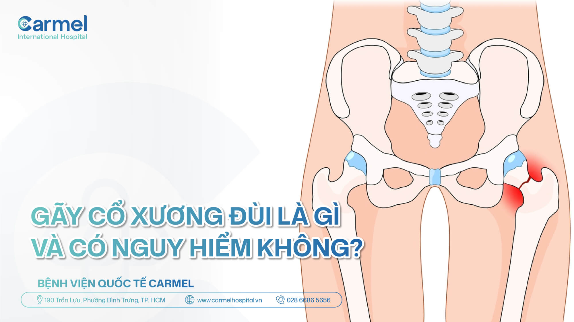 Gãy cổ xương đùi là gì? Có nguy hiểm không?
