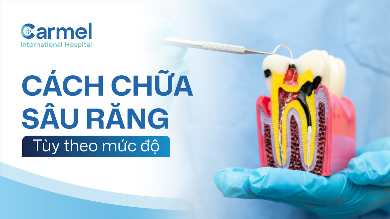 Sâu răng có chữa được không? Phương pháp điều trị theo từng mức độ