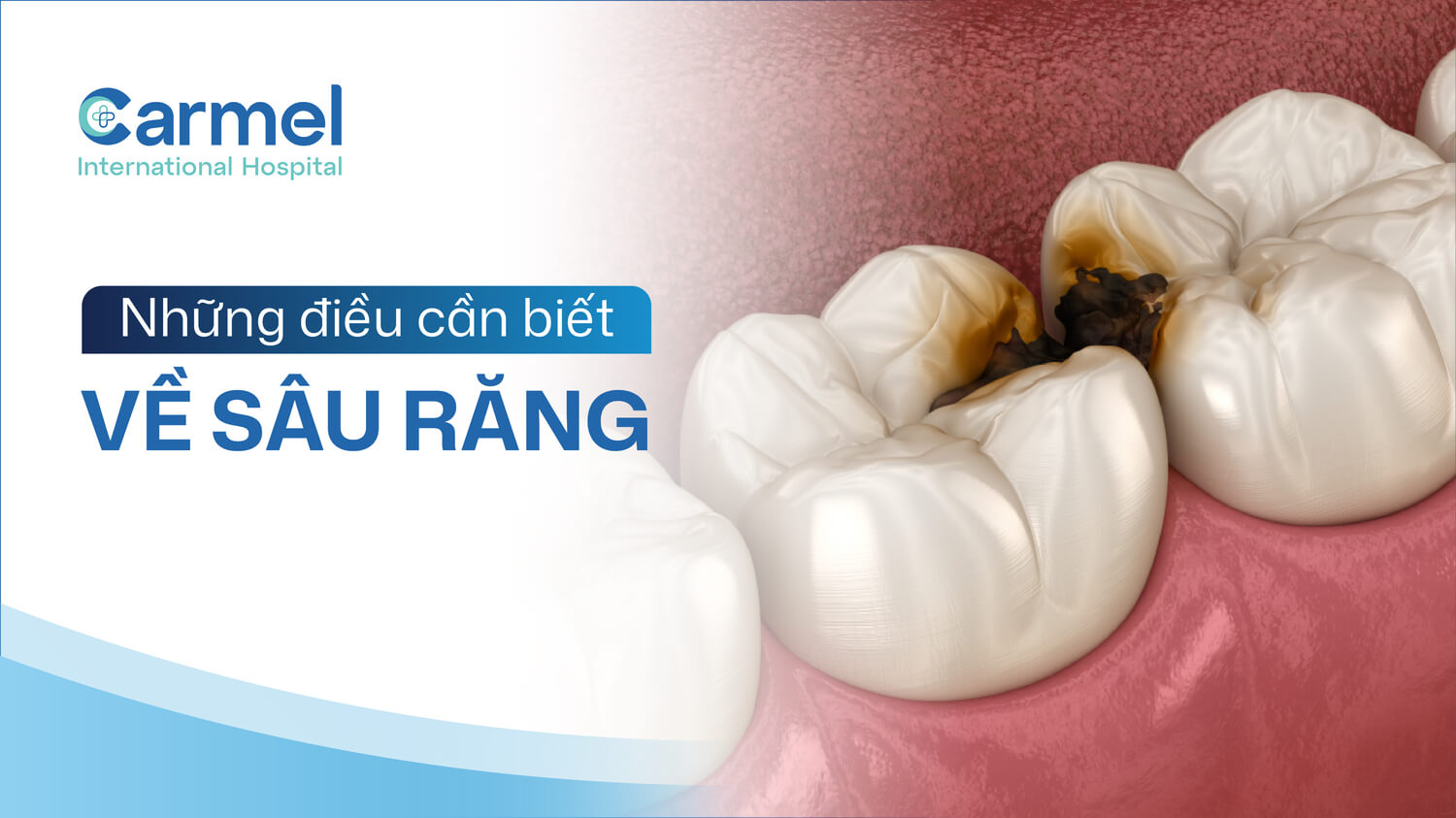 Sâu răng là gì? Dấu hiệu, nguyên nhân và cách điều trị hiệu quả