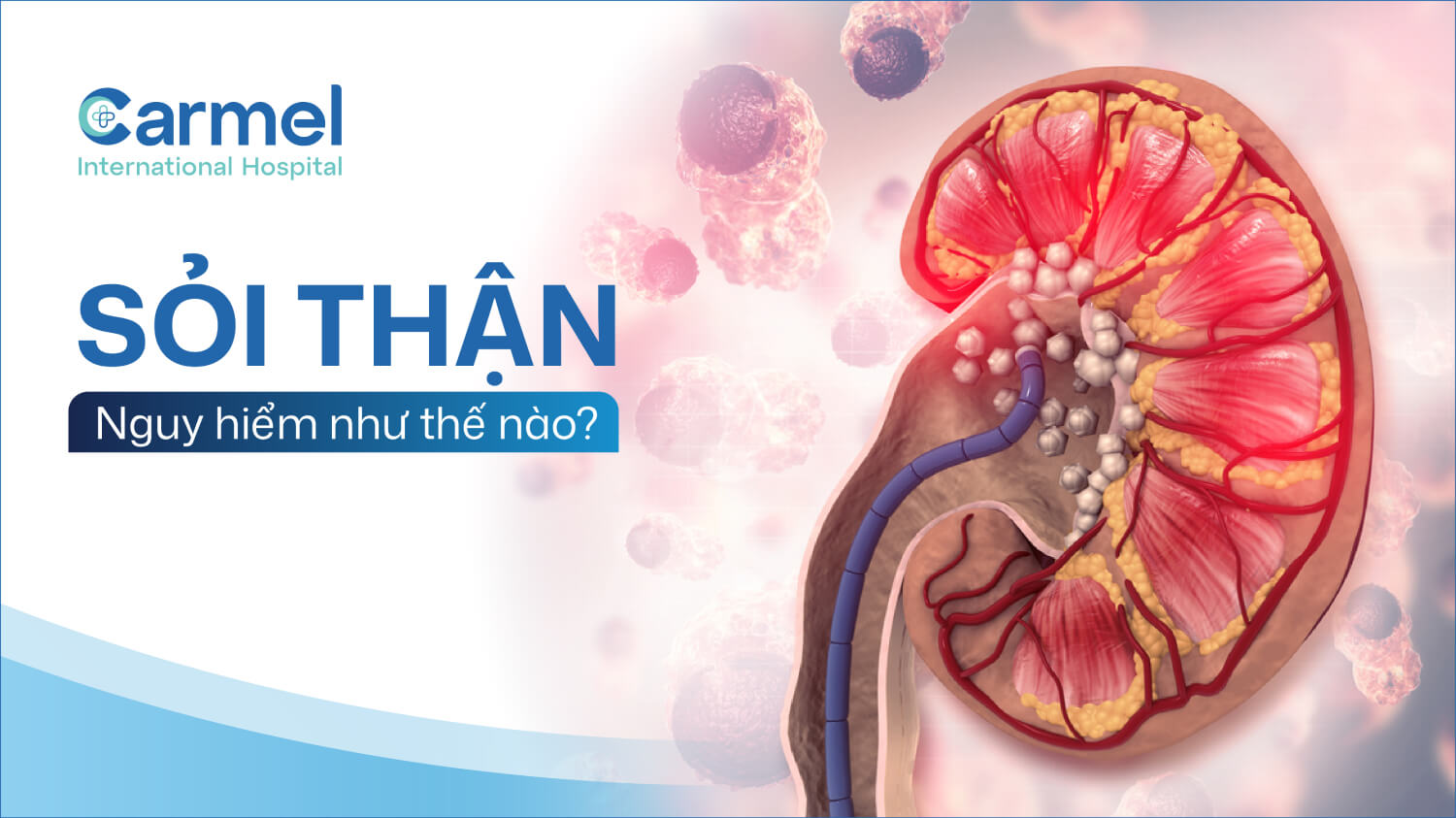Sỏi thận có nguy hiểm không? Những biến chứng cần cảnh giác