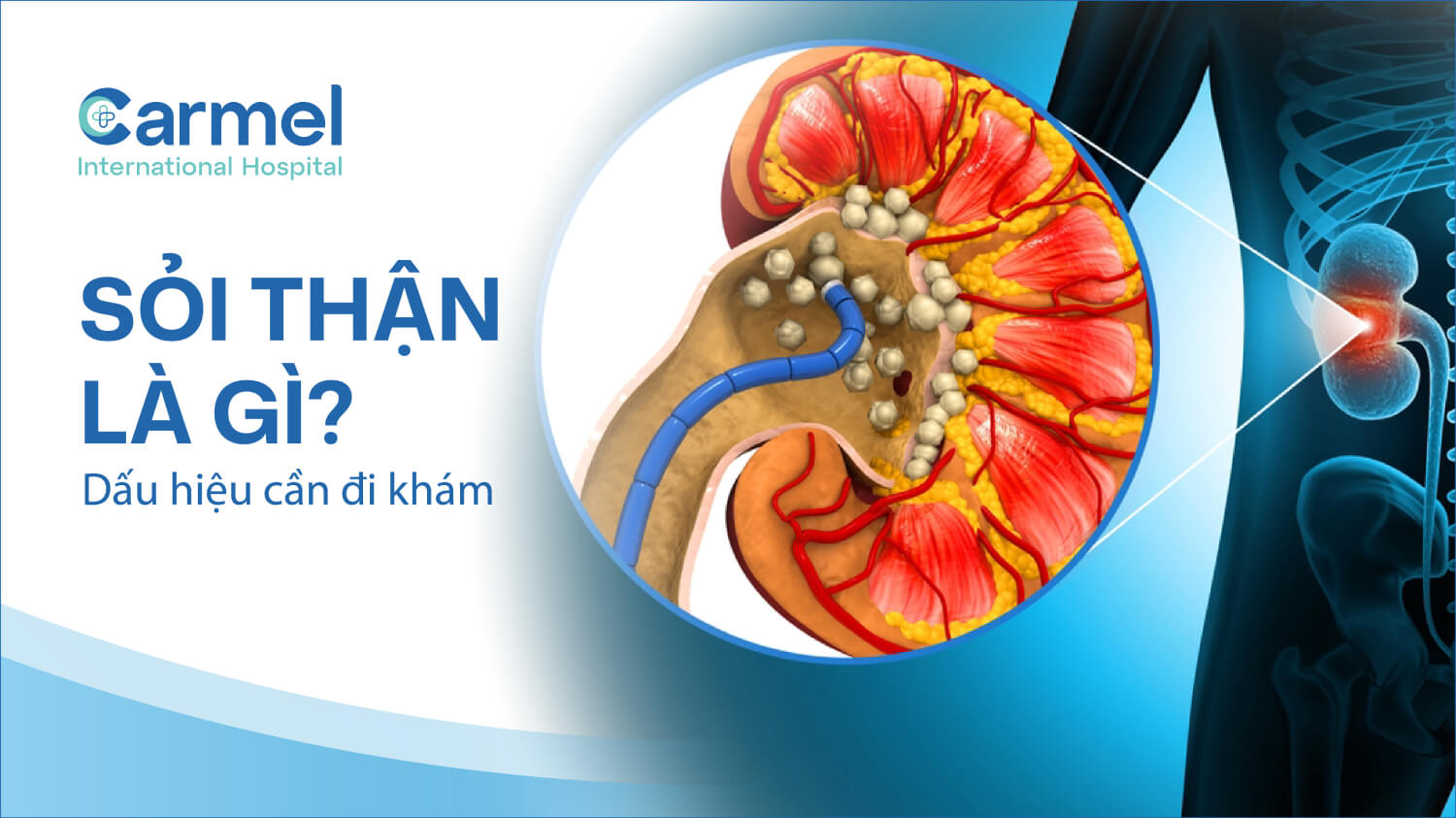Sỏi thận là gì? Dấu hiệu nhận biết và khi nào cần đi khám