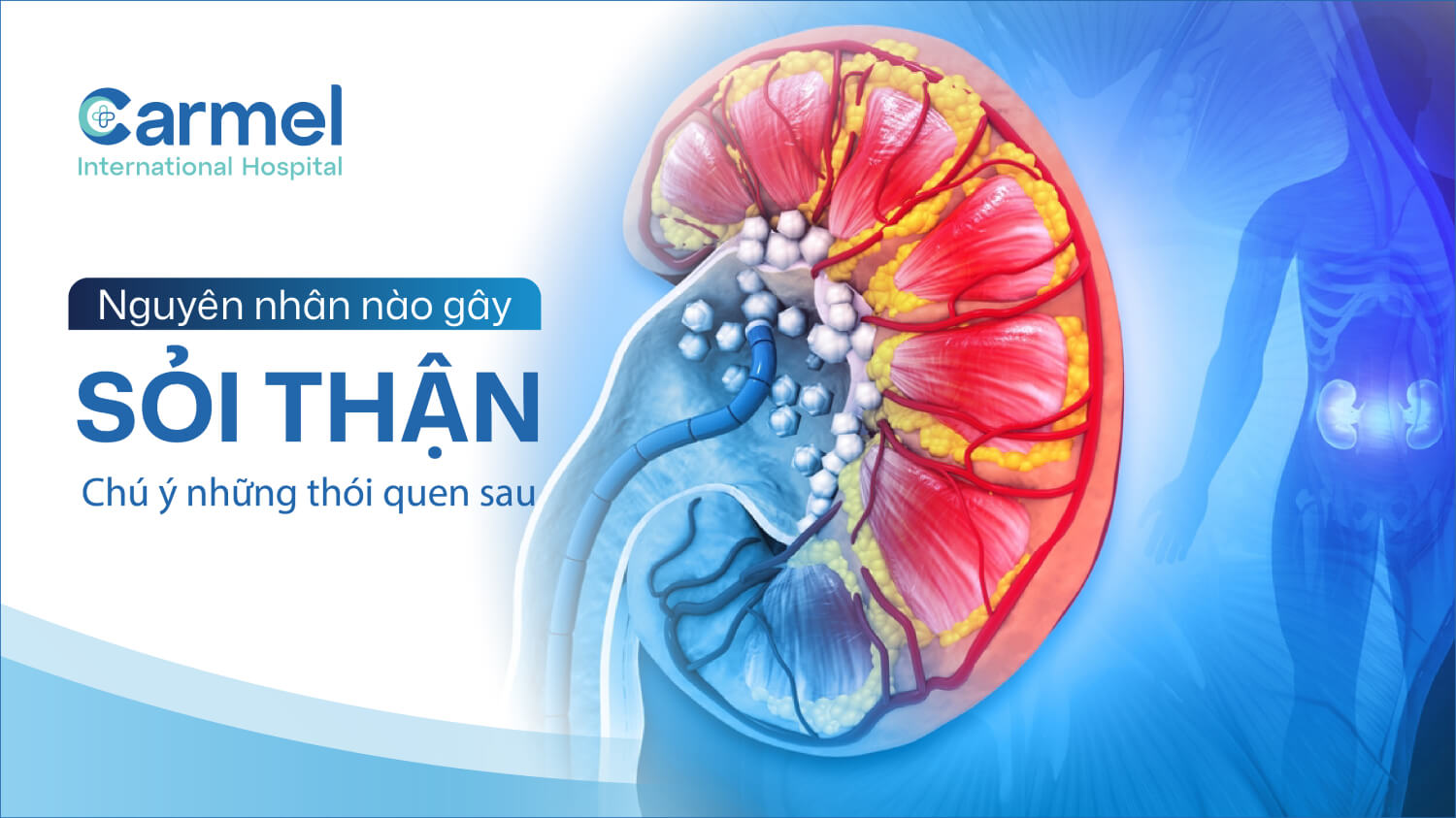 Vì sao bị sỏi thận? Những nguyên nhân và thói quen dễ mắc phải