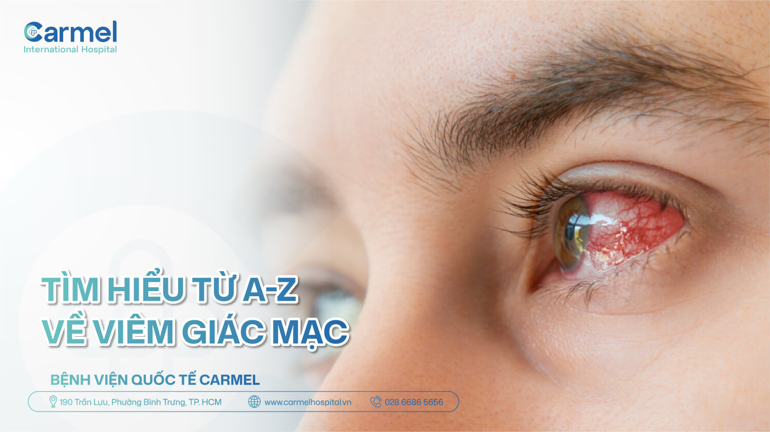 Viêm giác mạc là gì? Nguyên nhân, triệu chứng, cách điều trị & phòng ngừa từ A–Z